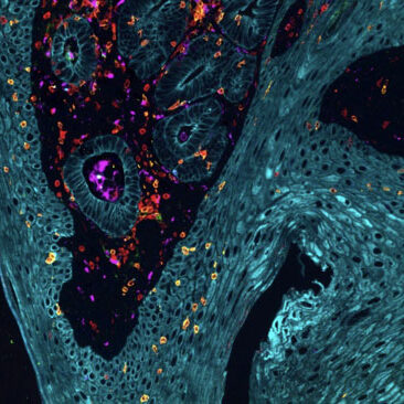 microscopic scan of a cancerous tumor before immunotherapy