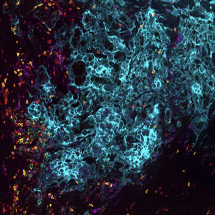 Digital scan of a cancerous tumor before immunotherapy